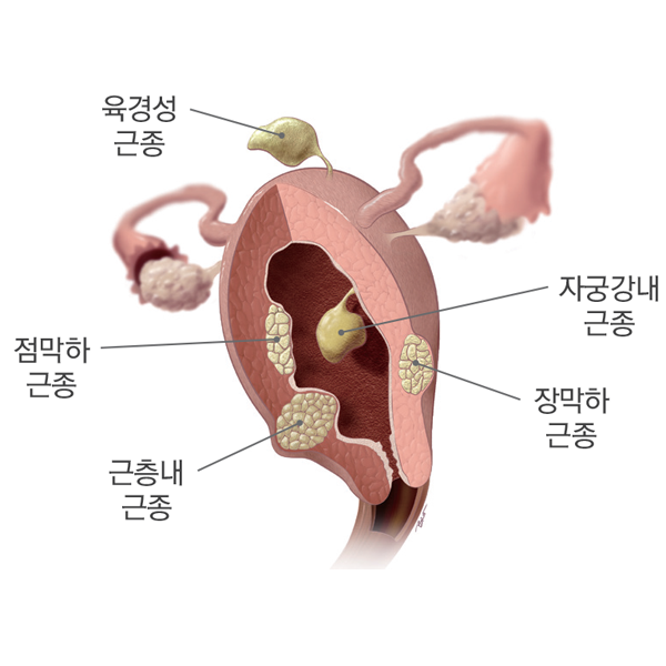 자궁근종