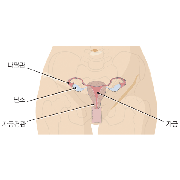 자궁내막증